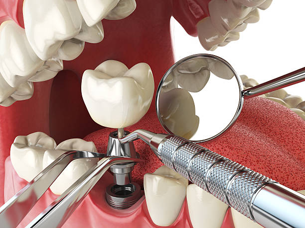 Best Emergency Dental Extractions in Van Wert, OH